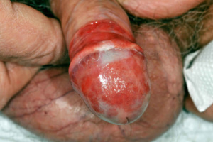 Urinary tract infections