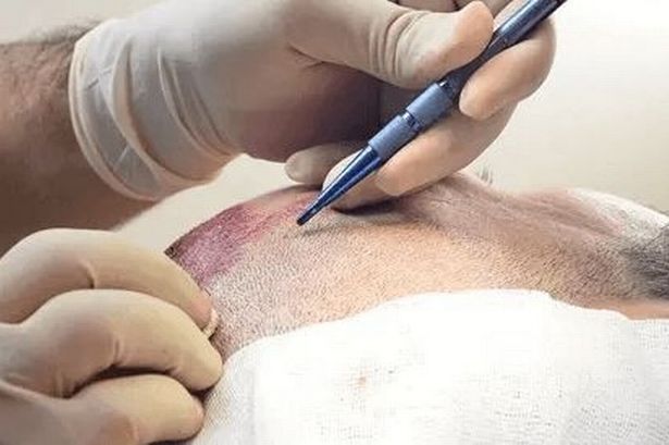 Step 2: Hair graft holding