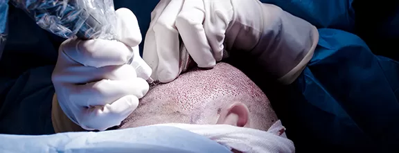 Step 1: Extraction of hair grafts