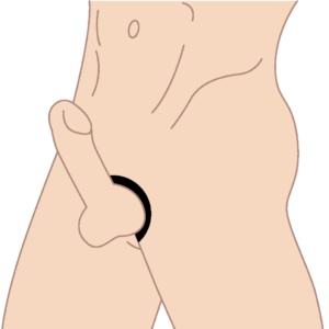 Penile Clamps and Rings