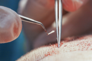 Step 4: Implantation of hair grafts