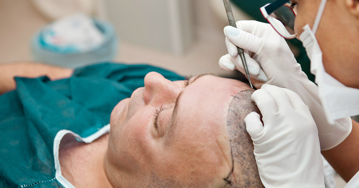 Hair Transplant