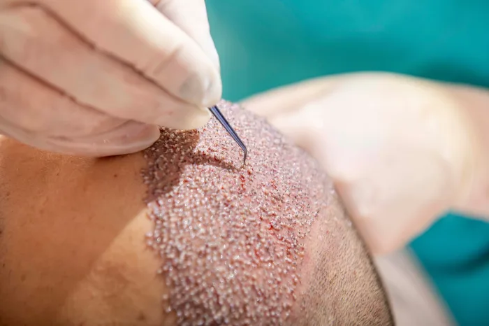 hair transplant
