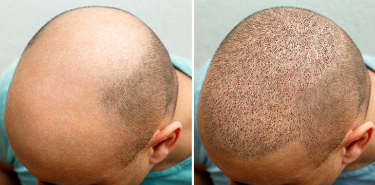 hair transplant recovery