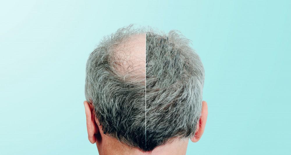 benefits of the FUE hair transplant