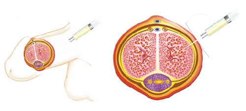 stem cell procedure for ED