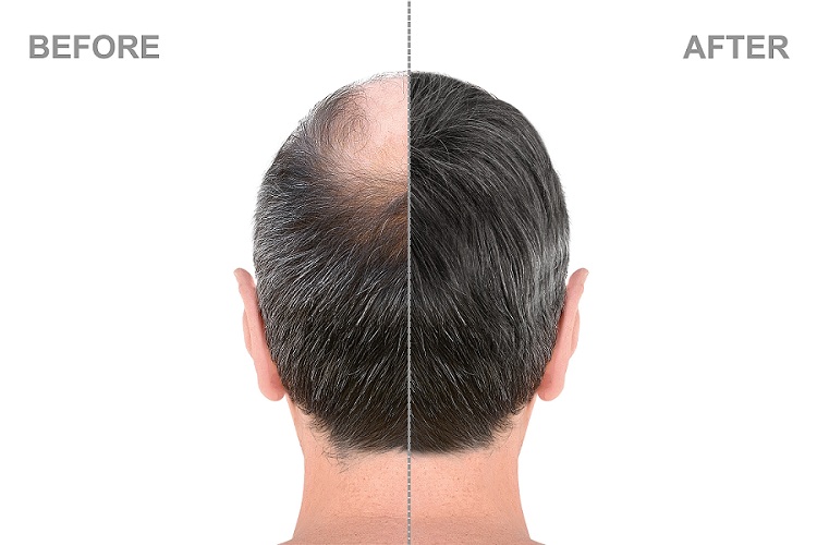 benefits of the FUE hair transplant