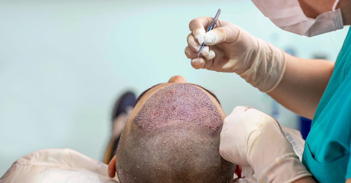 What is a FUE hair transplant?