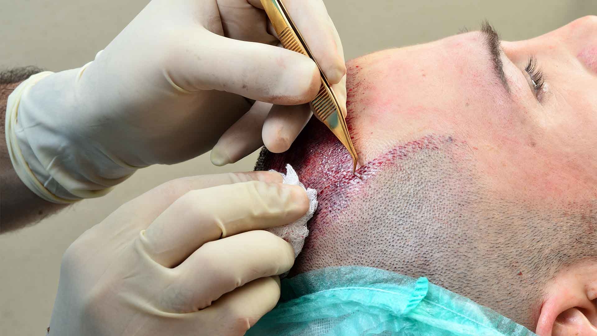 FUE hair transplant