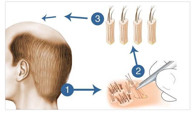 What is a FUE hair transplant?