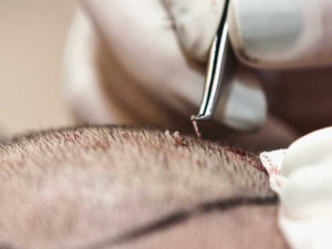 What is a FUE hair transplant?
