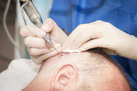 What is a FUE hair transplant?