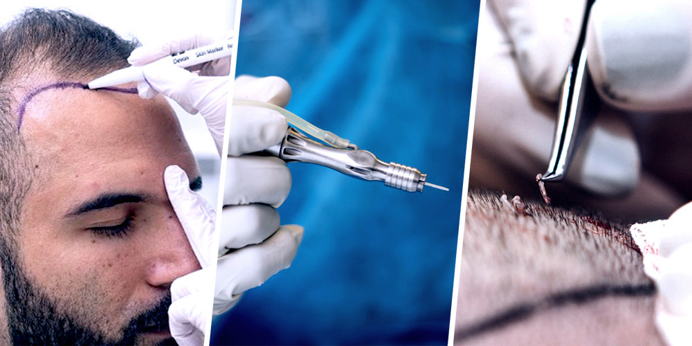 FUE HAIR TRANSPLANT 