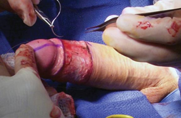 Adult Male Circumcision