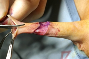 Adult Male Circumcision