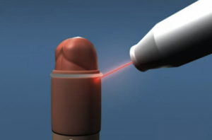 Laser Circumcision