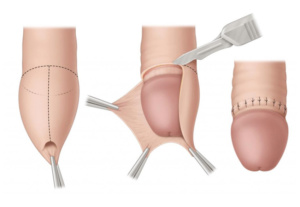 Open Circumcision