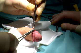 Adult Male Circumcision In Malaysia: Risks, Benefits & Recovery