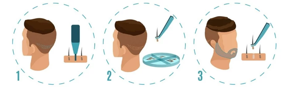 Recent Posts Popular Posts Unlock Your Handsome Potential : FUE Beard Transplant