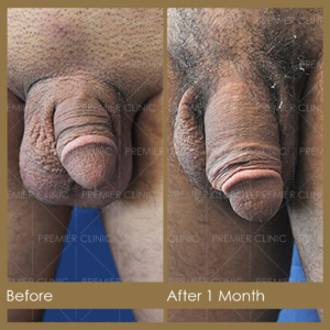 Premier Penis Enlargement Filler Before & After