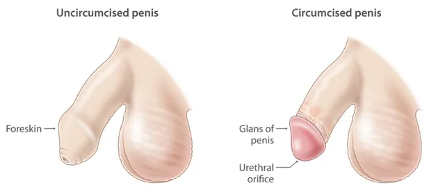 CONSIDERING CIRCUMCISION