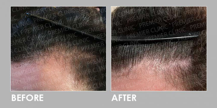 BEFORE & AFTER EXOSOME HAIR LOSS THERAPY