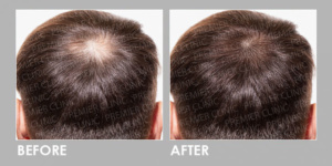 BEFORE & AFTER EXOSOME HAIR LOSS THERAPY