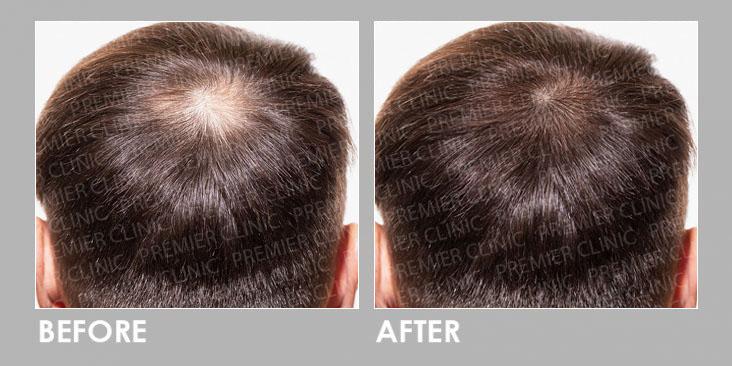 BEFORE & AFTER EXOSOME HAIR LOSS THERAPY