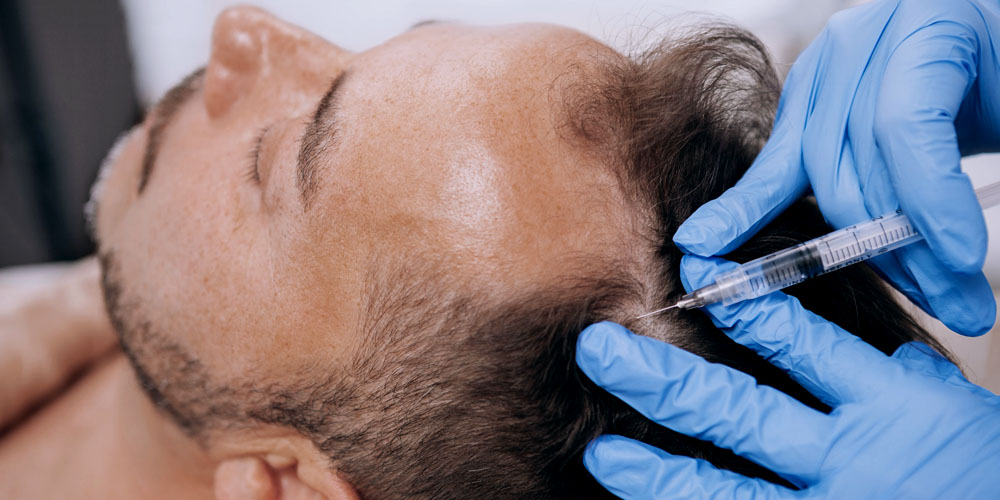 Exosome Therapy hair treatment for men 