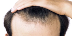 hair loss malaysia