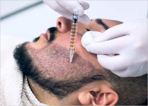 FUE BEARD TRANSPLANT before & after 
