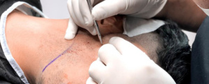 FUE Beard Transplant