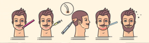 FUE BEARD TRANSPLANT before & after 