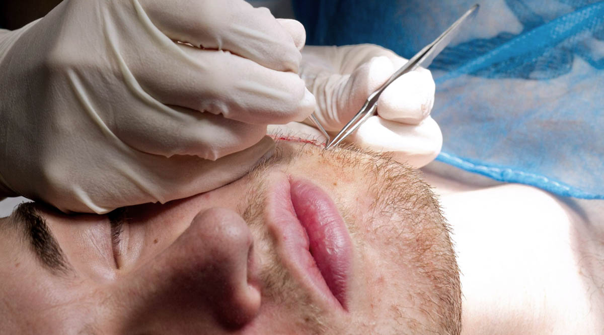 FUE Beard Transplant