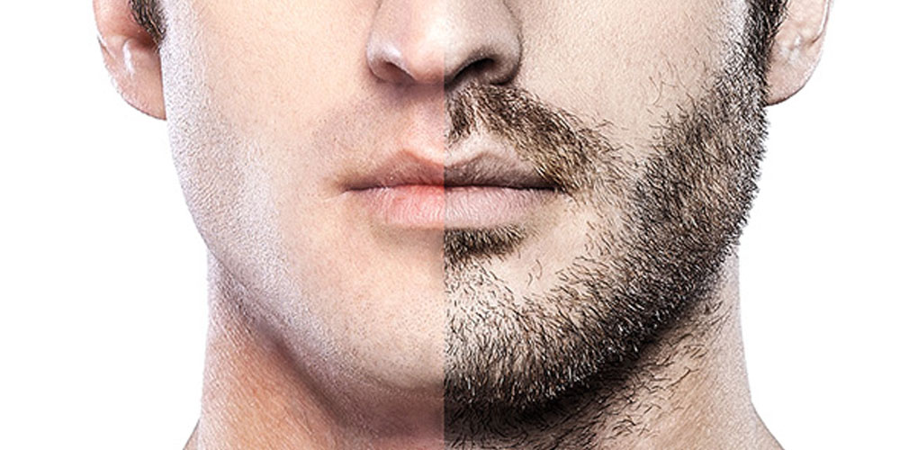 FUE Beard Transplant