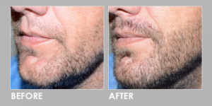 FUE BEARD TRANSPLANT before & after 