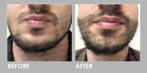 FUE BEARD TRANSPLANT before & after 