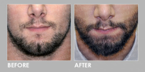 FUE BEARD TRANSPLANT before & after 