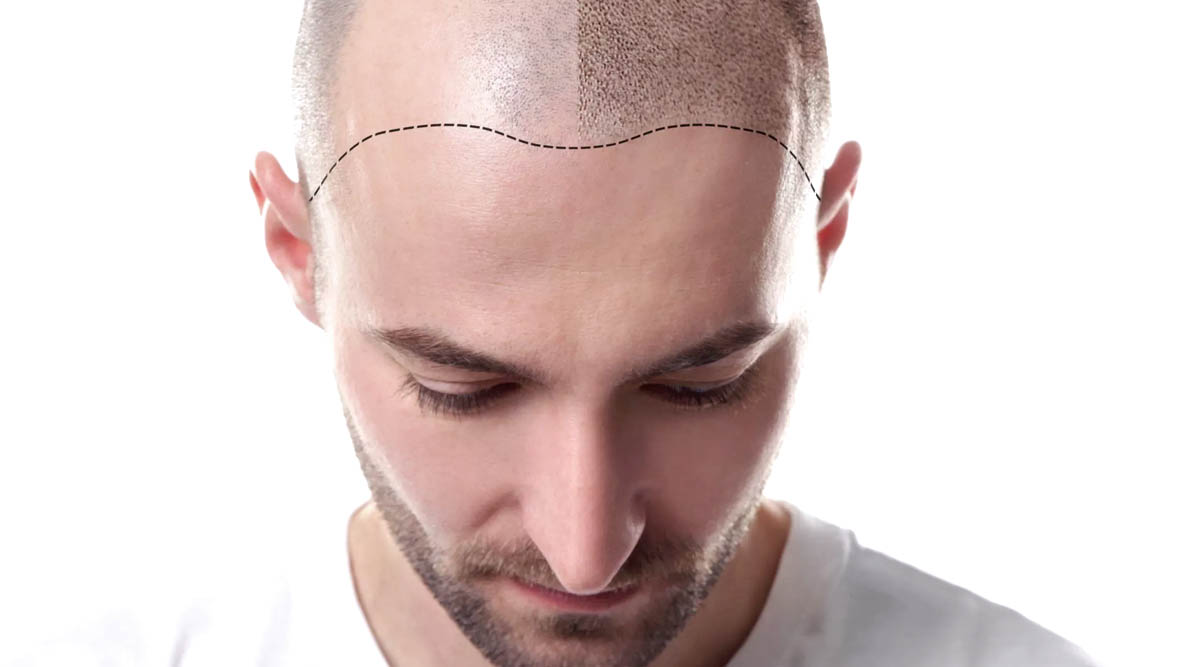 HAIR FOLLICLE ENHANCER WITH SMP