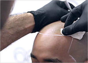 HAIR FOLLICLE ENHANCER WITH SMP