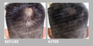 Hair Follicles Enhancer (Scalp Micropigmentation) before & after 