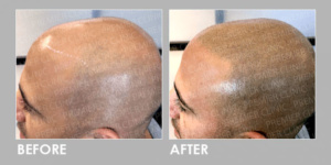 Hair Follicles Enhancer (Scalp Micropigmentation) before & after