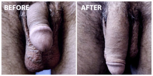 Penis Enlargement before & after
