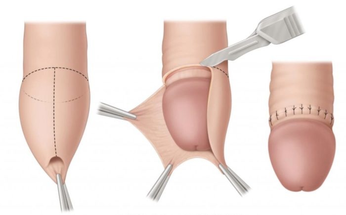 OPEN CIRCUMCISION