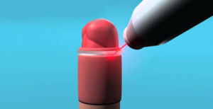 LASER CIRCUMCISION