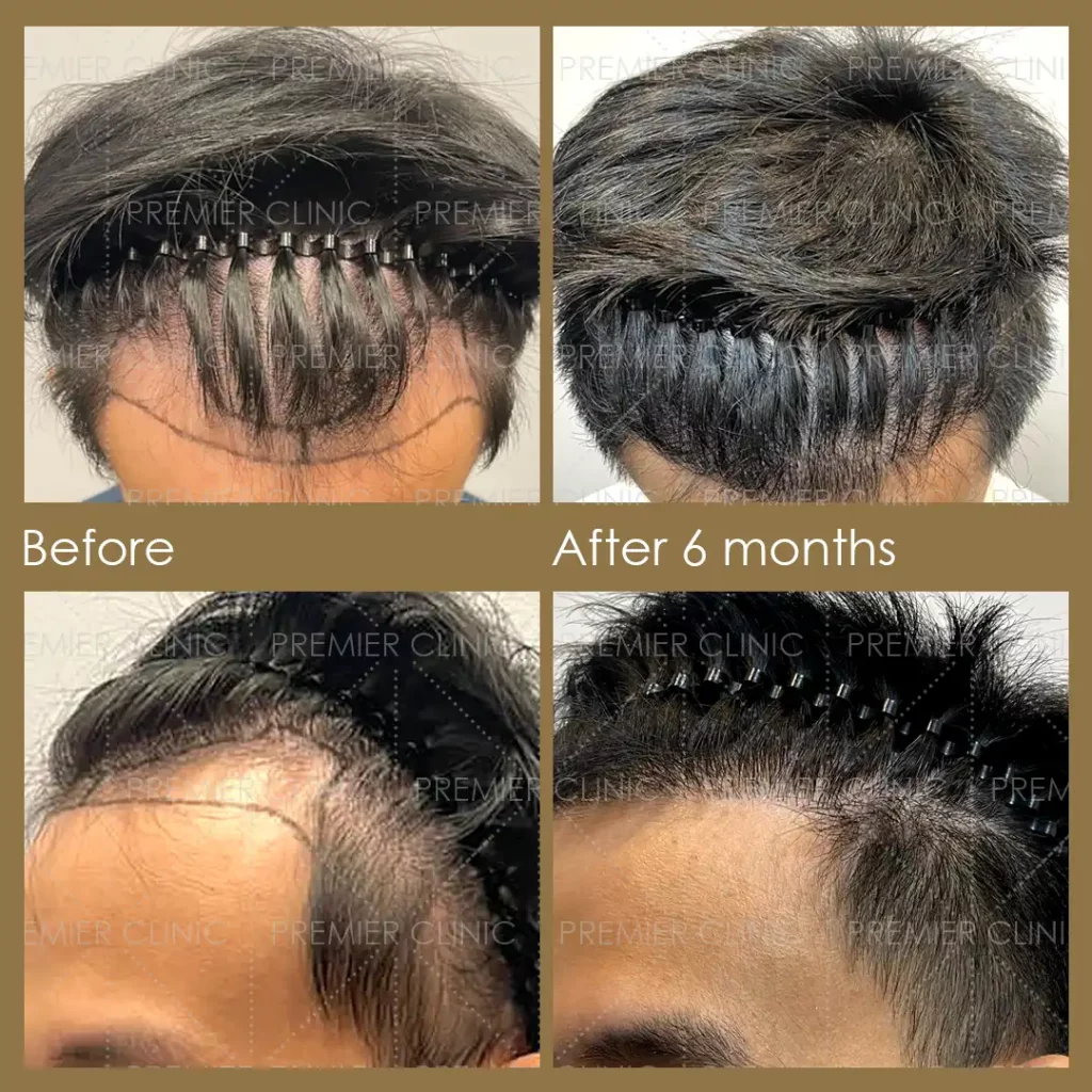 Premier FUE Before & After