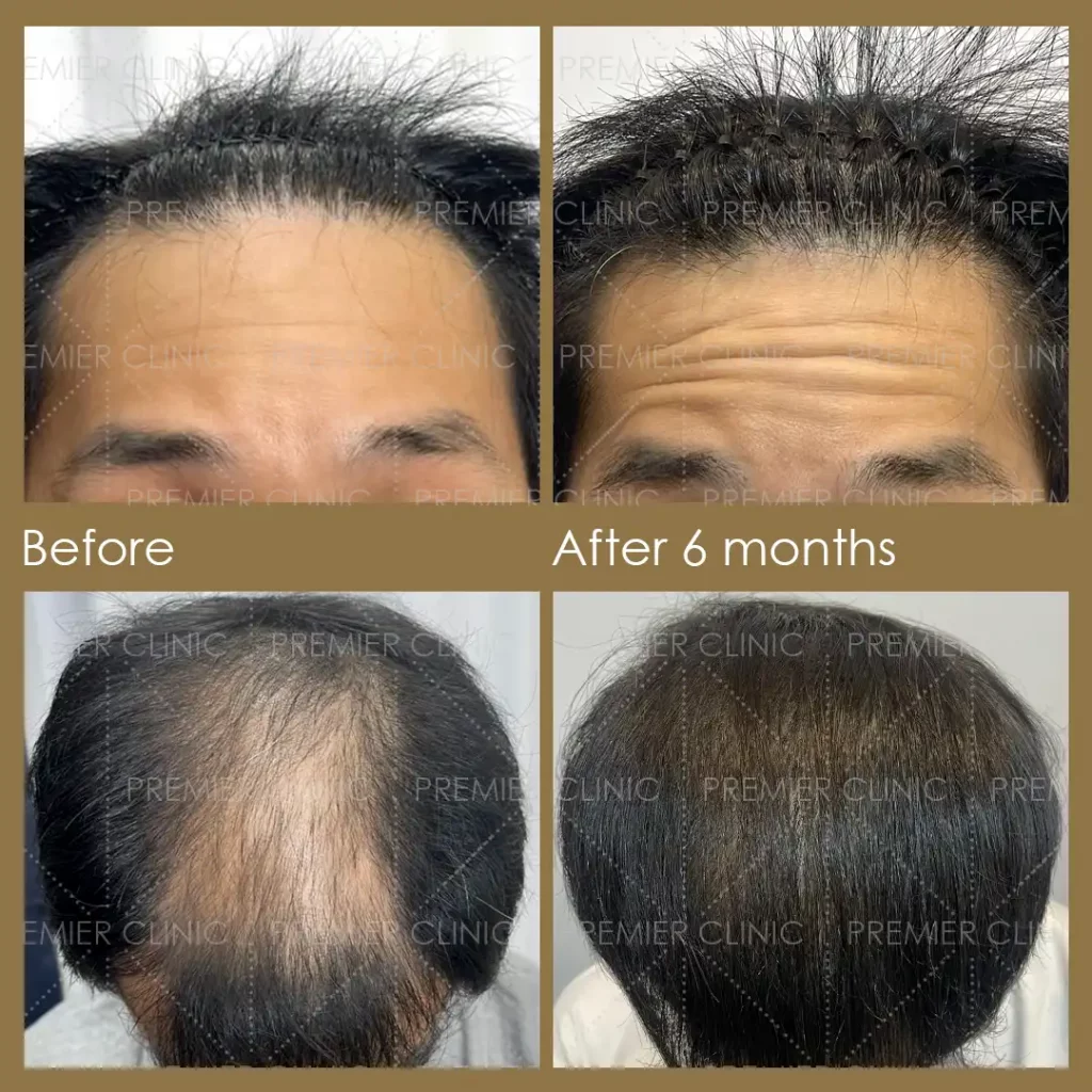 Premier FUE Before & After
