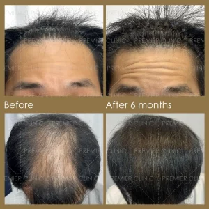Premier FUE Before & After