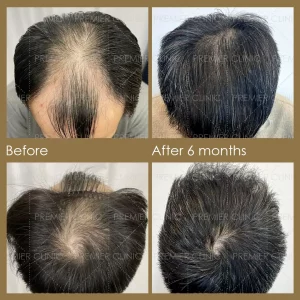Premier FUE Before & After