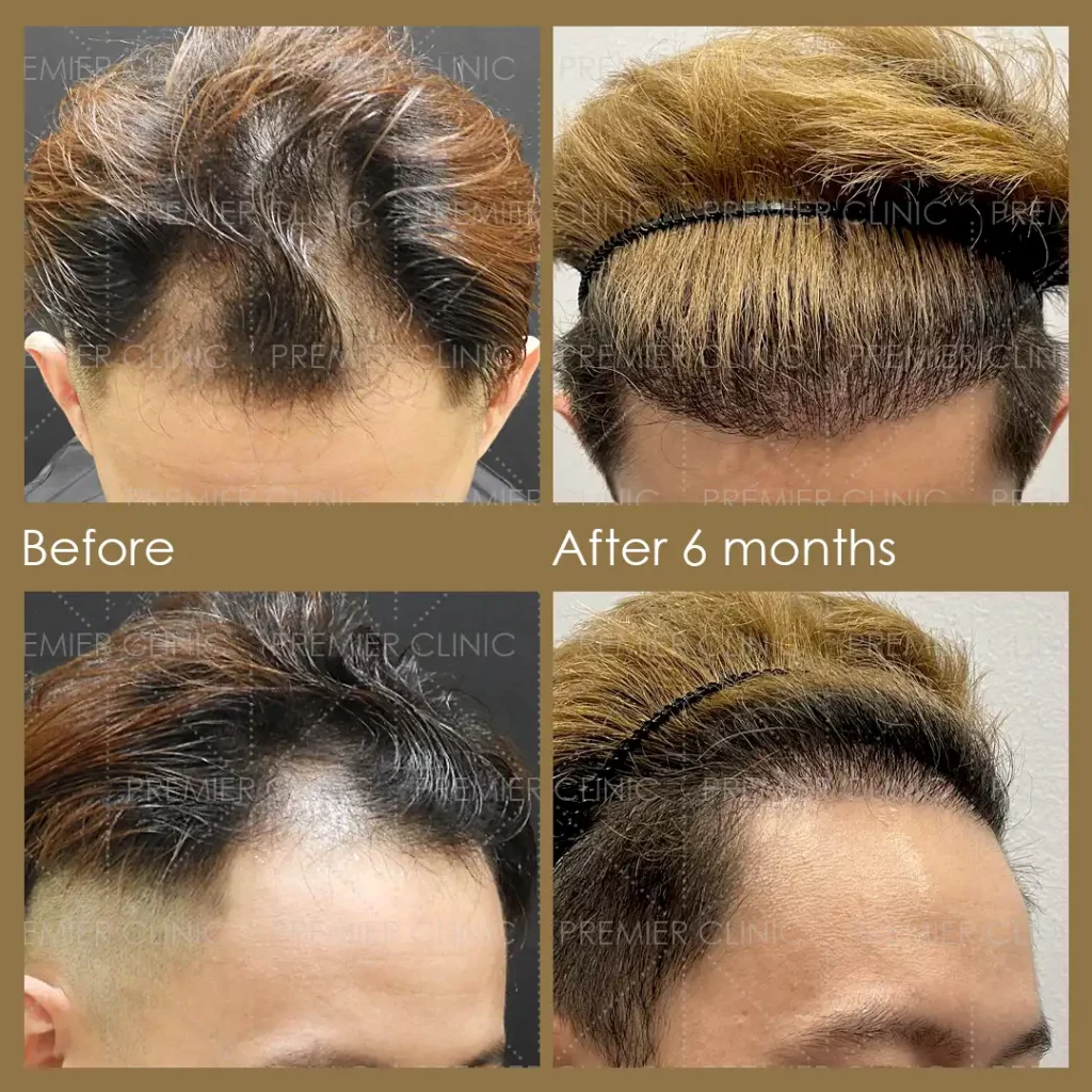Premier FUE Before & After